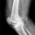 O uso do manguito pneumático em pacientes submetidos a artroplastia total do joelho com ou sem calcificação da artéria poplítea